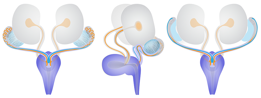 Sex-specific paramesonephric Mullerian and nephric Wolffian duct degeneration. Schematic diagrams show 3-dimensional views of the urogenital system at approximately TS23 15 dpc . Diagrams are dorsal views left and far right and a lateral or side view centre . The relationship between the gonads, testes in male and ovaries in female light blue , bladder - pelvic urethra purple and kidneys - ureters grey is shown. The epithelium lining the ureters and kidney pelvis are shown in orange. In the male left and centre , within the mesonephros grey , the paramesonephric duct blue degenerates in a rostral to caudal anterior to posterior direction, whilst the anterior portion of the nephric duct orange has developed into the epididymis orange . Also within the mesonephros, cranial mesonephric tubules dark grey will later develop into efferent ducts, connecting the testis to the epididymis. Conversely in the female far right , the nephric ducts orange and mesonephric tubules grey degenerate, whilst the paramesonephric ducts blue will become the oviducts, vagina, cervix and uterus. In males and females at TS23, the caudal portions of the nephric and paramesonephric ducts appear morphologically identical. They connect to the dorsal pelvic urethra right of centre diagram at a region called the urogenital sinus ridge, with the paramesonephric ducts located medially and the nephric ducts either side. This is in contrast to their orientation in the rostral mesonephros, where the nephric ducts are located medially. Diagram modified from: An illustrated anatomical ontology of the developing mouse lower urogenital tract. Georgas et al.